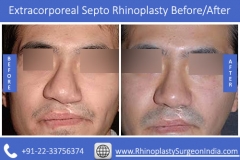 Extracorporeal-Septo-Rhinoplasty-4