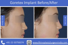 Goretex-Implant-1