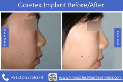 Goretex-Implant-4