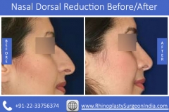 Nasal-Dorsal-Reduction-3