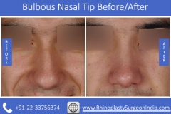 Bulbous-Nasal-Tip-4