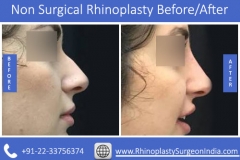 Non-Surgical-Rhinoplasty-4