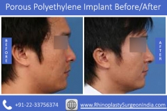 Porous-Polyethylene-Implant-1