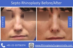 Septo-Rhinoplasty-2