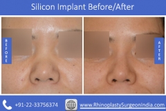 Silicon-Implant-1