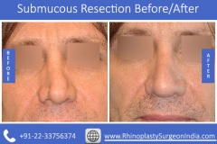 Submucous-Resection-3