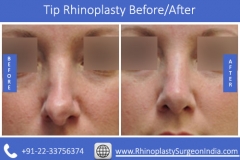Tip-Rhinoplasty-1