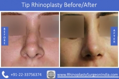 Tip-Rhinoplasty-4