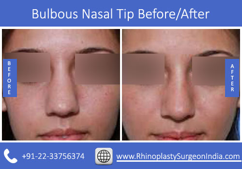 Bulbous-Nasal-Tip-1