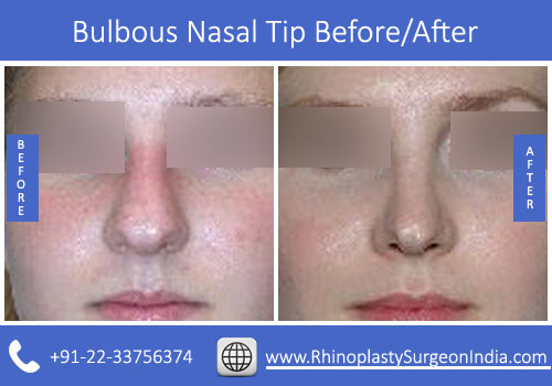 Bulbous-Nasal-Tip-2