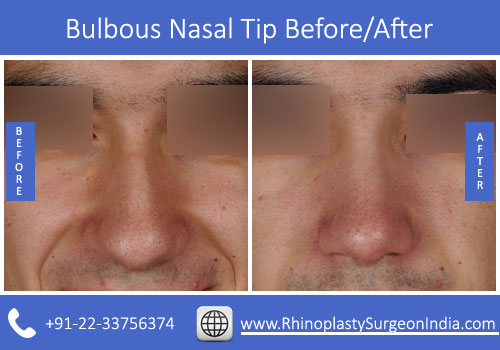 Bulbous-Nasal-Tip-4