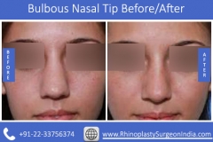 Bulbous-Nasal-Tip-1