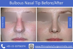 Bulbous-Nasal-Tip-2