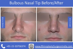 Bulbous-Nasal-Tip-3