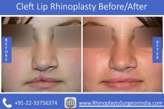 Cleft-Lip-Rhinoplasty-4