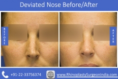 Deviated-Nose-2