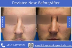 Deviated-Nose-4