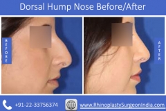 Dorsal-Hump-Nose-2