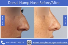 Dorsal-Hump-Nose-1