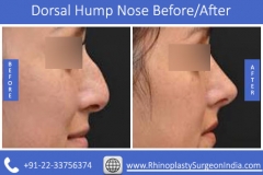 Dorsal-Hump-Nose-3