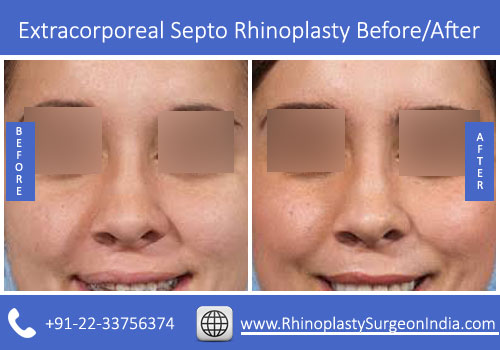 Extracorporeal-Septo-Rhinoplasty-2