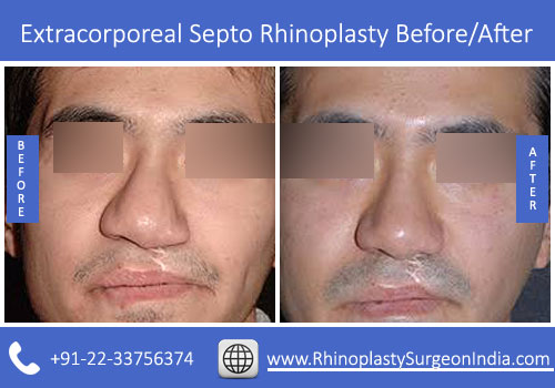 Extracorporeal-Septo-Rhinoplasty-4