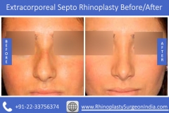 Extracorporeal-Septo-Rhinoplasty-3