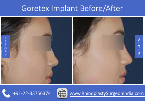 Goretex-Implant-1