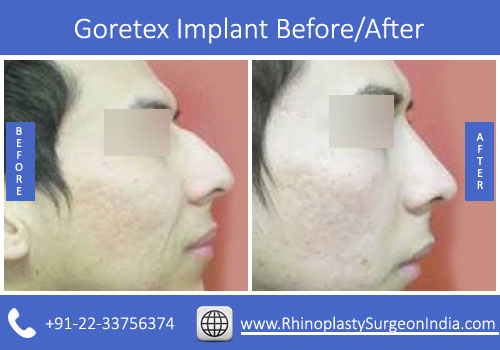 Goretex-Implant-3