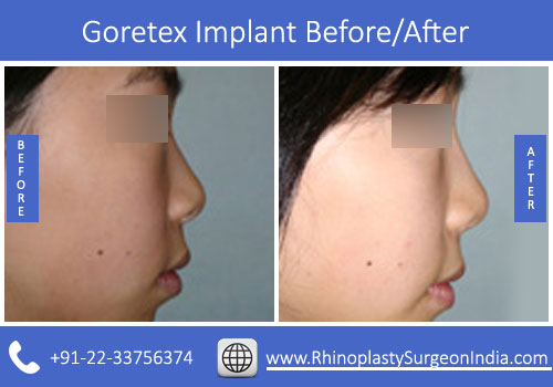 Goretex-Implant-4