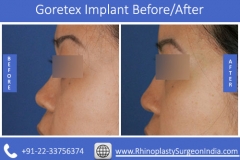 Goretex-Implant-2