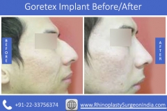 Goretex-Implant-3