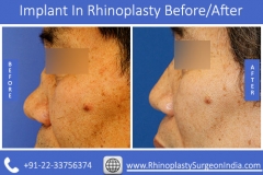 Implant-In-Rhinoplasty-3