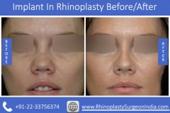 Implant-In-Rhinoplasty-1