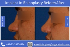 Implant-In-Rhinoplasty-2