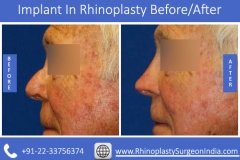 Implant-In-Rhinoplasty-4