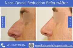 Nasal-Dorsal-Reduction-4