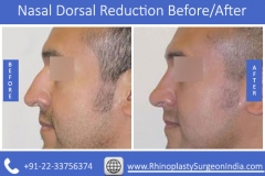 Nasal-Dorsal-Reduction-1