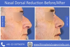 Nasal-Dorsal-Reduction-2