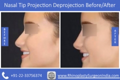Nasal-Tip-Projection-Deprojection-2