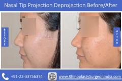 Nasal-Tip-Projection-Deprojection-3