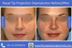 Nasal-Tip-Projection-Deprojection-4