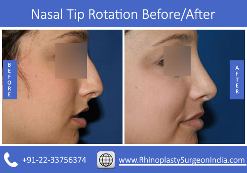Nasal-Tip-Rotation-2