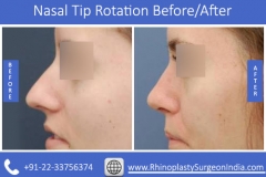 Nasal-Tip-Rotation-1