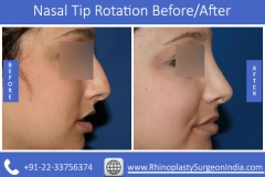 Nasal-Tip-Rotation-2