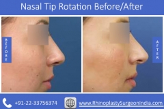Nasal-Tip-Rotation-4