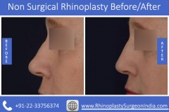 Non-Surgical-Rhinoplasty-1