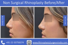 Non-Surgical-Rhinoplasty-2