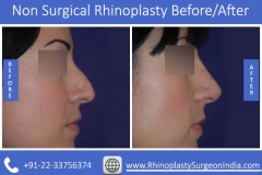 Non-Surgical-Rhinoplasty-3