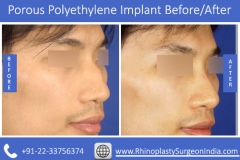 Porous-Polyethylene-Implant-3